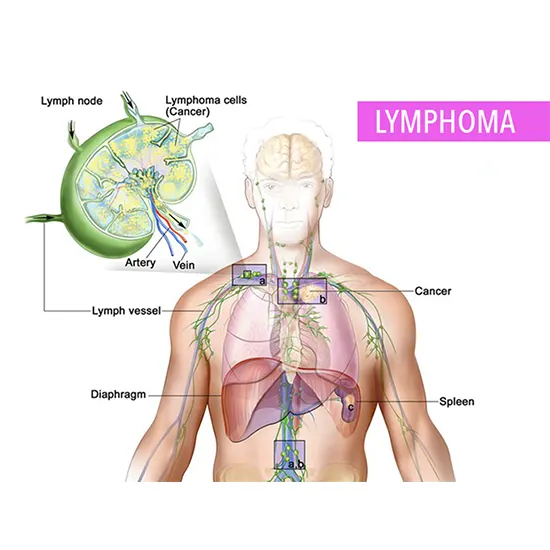 lymphoma cancer package test